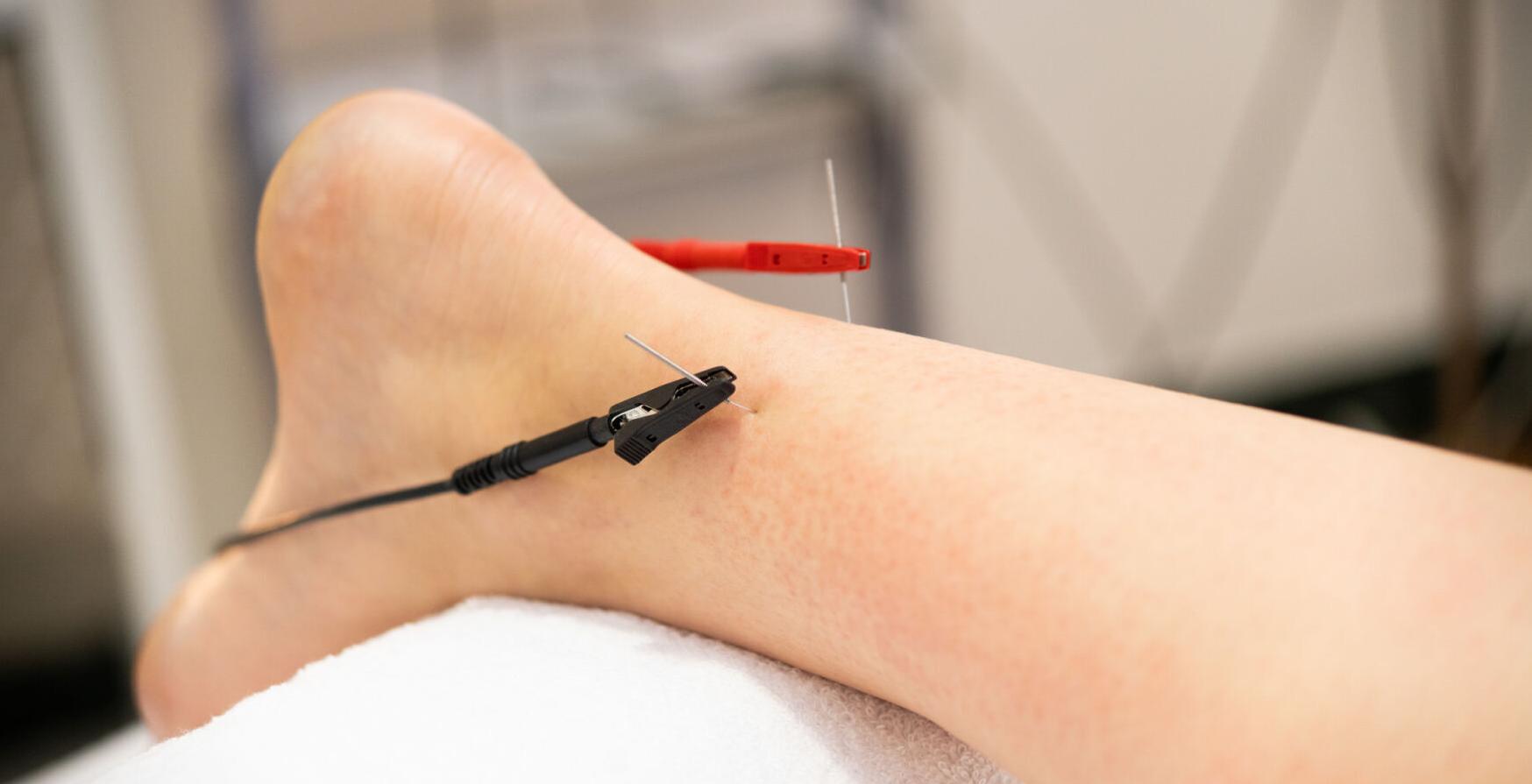Electro-acupuncture dry with needle connecting machine